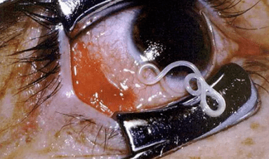 Types de parasites dans le corps humain